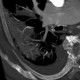 Thrombosis of the pulmonary vein: CT - Computed tomography