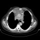 Thymoma, malignant thymoma, treatment: CT - Computed tomography