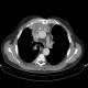 Thymoma, malignant thymoma, treatment: CT - Computed tomography