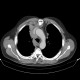 Thymoma, malignant thymoma, treatment: CT - Computed tomography