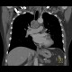Castleman's disease: CT - Computed tomography