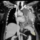 Tumour of thorax wall: CT - Computed tomography
