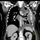 Tumour of thorax wall: CT - Computed tomography