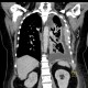 Tumour of thorax wall: CT - Computed tomography