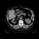 Renal carcinoma, treatment with RFA, follow-up: CT - Computed tomography