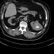 Renal carcinoma, treatment with RFA, follow-up: CT - Computed tomography