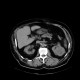 Renal carcinoma, treatment with RFA, follow-up: CT - Computed tomography