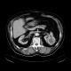 Renal carcinoma, treatment with RFA, follow-up: CT - Computed tomography