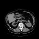 Renal carcinoma, treatment with RFA, follow-up: CT - Computed tomography