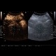 Renal carcinoma, treatment with RFA, follow-up, CEUS: US - Ultrasound