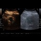 Renal carcinoma, treatment with RFA, follow-up, CEUS: US - Ultrasound