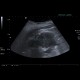 Renal carcinoma, treatment with RFA, follow-up, CEUS: US - Ultrasound
