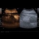 Renal carcinoma, treatment with RFA, follow-up, CEUS: US - Ultrasound