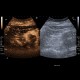 Renal carcinoma, treatment with RFA, follow-up, CEUS: US - Ultrasound