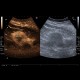 Renal carcinoma, treatment with RFA, follow-up, CEUS: US - Ultrasound
