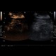 Renal carcinoma, treatment with RFA, follow-up, CEUS: US - Ultrasound