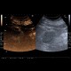 Renal carcinoma, treatment with RFA, follow-up, CEUS: US - Ultrasound