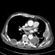 Lung tumour, osteolytic metastasis of ribs: CT - Computed tomography
