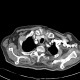 Lung tumour, osteolytic metastasis of ribs: CT - Computed tomography