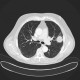Lung tumour, bone metastasis in pubic bone, inguinal hernia: CT - Computed tomography