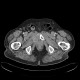 Lung tumour, bone metastasis in pubic bone, inguinal hernia: CT - Computed tomography