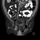 Lung tumour, bone metastasis in pubic bone, inguinal hernia: CT - Computed tomography