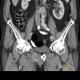 Lung tumour, bone metastasis in pubic bone, inguinal hernia: CT - Computed tomography