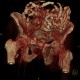 Lung tumour, bone metastasis in pubic bone, inguinal hernia: CT - Computed tomography