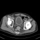 Pyelocystitis, narrowing of calyceal neck, tumour of rectum: CT - Computed tomography