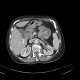 Stomach tumour, enlarged regional lymph nodes: CT - Computed tomography