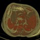Stomach tumour, enlarged regional lymph nodes, VRT: CT - Computed tomography