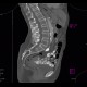 Tarlov cyst, calcified: CT - Computed tomography