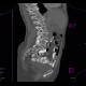 Tarlov cyst, calcified: CT - Computed tomography