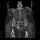Tarlov cyst, calcified: CT - Computed tomography