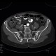 Tarlov cyst, calcified: CT - Computed tomography