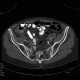 Tarlov cyst, calcified: CT - Computed tomography