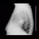 Pleural effusion, loculated, fissure: X-ray - Plain radiograph