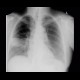 Pleural effusion, loculated, fissure: X-ray - Plain radiograph