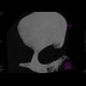 Fissure of frontal bone: CT - Computed tomography