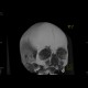 Fissure of frontal bone: CT - Computed tomography