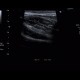 Terminal ileitis: US - Ultrasound