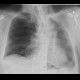Thoracoplasty: X-ray - Plain radiograph