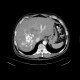 Liver metastases of carcinoid, embolization: CT - Computed tomography