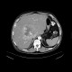 Liver metastases of carcinoid, embolization: CT - Computed tomography