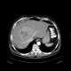 Liver metastases of carcinoid, embolization: CT - Computed tomography