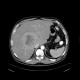 Liver metastases of carcinoid, embolization: CT - Computed tomography