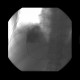 Liver metastases of carcinoid, embolization: AG - Angiography