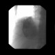 Liver metastases of carcinoid, embolization: AG - Angiography