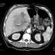 Thrombosis of mesenteric and portal vein, venous infarction of small bowel loops: CT - Computed tomography