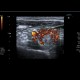Thyroid nodule: US - Ultrasound